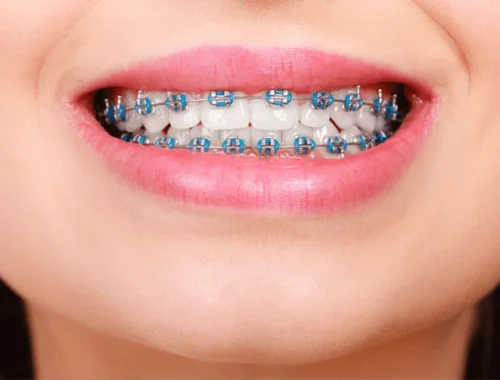 Имплантация зубов под ключ: от диагностики до протезирования. Что нужно знать перед лечением