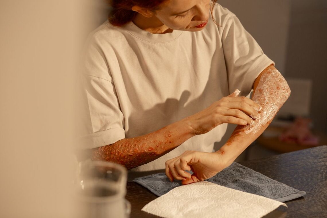 Первая помощь при ожоге: как правильно действовать и не допустить ошибок